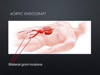 Bilateral groin incisions
 