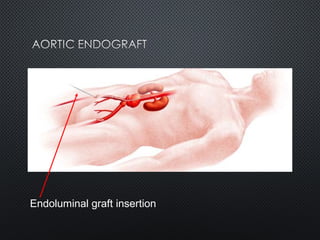 Endoluminal graft insertion
 