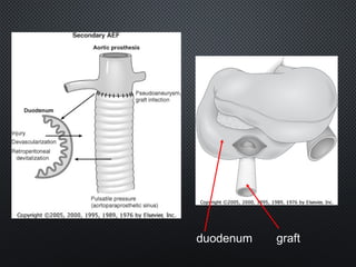 duodenum graft
 