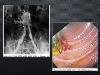 Abdomianl Aortic Aneurysm (AAA)