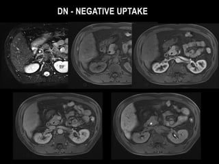 DN - NEGATIVE UPTAKE

 