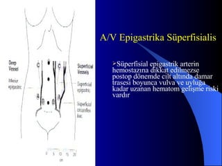 A/V Epigastrika Süperfisialis Süperfisial epigastrik arterin hemostazına dikkat edilmezse postop dönemde cilt altında damar trasesi boyunca vulva ve uyluğa kadar uzanan hematom gelişme riski vardır 