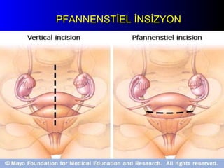 PFANNENSTİEL İNSİZYON 