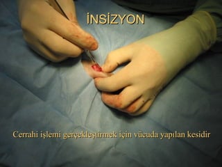 İNSİZYON Cerrahi işlemi gerçekleştirmek için vücuda yapılan kesidir  