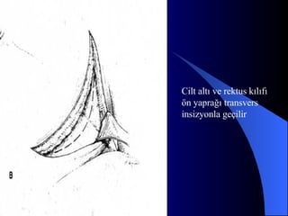 Cilt altı ve rektus kılıfı  ön yaprağı transvers  insizyonla geçilir 