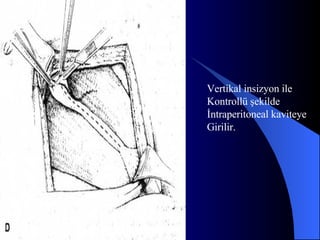 Vertikal insizyon ile  Kontrollü şekilde  İntraperitoneal kaviteye Girilir. 
