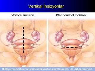 Vertikal İnsizyonlar 