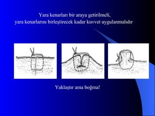 Yara kenarları bir araya getirilmeli,  yara kenarlarını birleştirecek kadar kuvvet uygulanmalıdır Yaklaştır ama boğma! 
