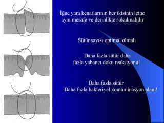 İğne yara kenarlarının her ikisinin içine aynı mesafe ve derinlikte sokulmalıdır  Sütür sayısı optimal olmalı Daha fazla sütür daha  fazla yabancı doku reaksiyonu! Daha fazla sütür  Daha fazla bakteriyel kontaminasyon alanı! 