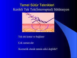 Temel Sütür Teknikleri Kesikli Tek Tek(İnterrupted) Sütürasyon Tek tek konur ve bağlanır Çok zaman alır  Kozmetik olarak tatmin edici değildir? 