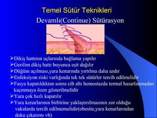 Temel Sütür Teknikleri Devamlı(Continue) Sütürasyon Dikiş hattının uçlarında bağlama yapılır Gerilim dikiş hattı boyunca eşit dağılır Düğüm açılması,yara kenarında yırtılma daha azdır Enfeksiyon riski varlığında tek tek sütürler tercih edilmelidir Fasya kapatıldıktan sonra cilt altı hemostazda termal hasarlanmadan  kaçınmaya özen gösterilmelidir Yara çok hızlı kapatılır Yara kenarlarının birbirine yaklaştırılmasının zor olduğu vakalarda tercih edilmemelidir(obesite,yara kenarlarından  doku çıkarımı vb) 