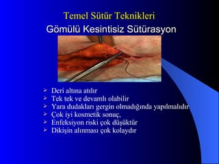 Gömülü Kesintisiz Sütürasyon Deri altına atılır Tek tek ve devamlı olabilir Yara dudakları gergin olmadığında yapılmalıdır Çok iyi kosmetik sonuç, Enfeksiyon riski çok düşüktür Dikişin alınması çok kolaydır Temel Sütür Teknikleri 