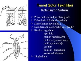 Temel Sütür Teknikleri Retansiyon Sütürü Primer dikişin açılma olasılığında  Daha derin dokular desteklenir Monoflaman naylon(no.5) Deri,deri altı,fasya,rektus kası geçilir Kimlere uygulanır: aşırı kilo malign hastalık,DM mükerrer yara açılması enfeksiyon varlığı yaşlılar dolaşım  bozukluğu kortizon kullanımı 14 gün kalır 