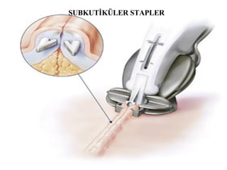 SUBKUTİKÜLER STAPLER 