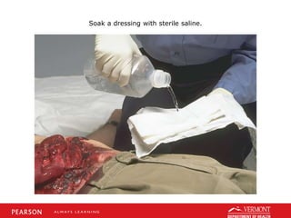 Soak a dressing with sterile saline.
 