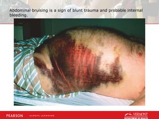 Abdominal bruising is a sign of blunt trauma and probable internal
bleeding.
 