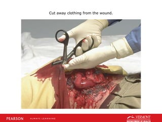 Cut away clothing from the wound.
 