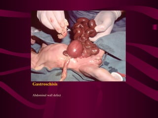 Gastroschisis

Abdominal wall defect
 