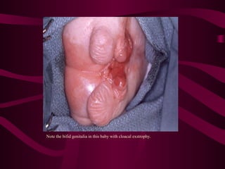 Note the bifid genitalia in this baby with cloacal exstrophy.
 