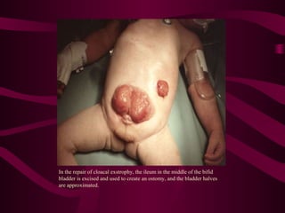 In the repair of cloacal exstrophy, the ileum in the middle of the bifid
bladder is excised and used to create an ostomy, and the bladder halves
are approximated.
 