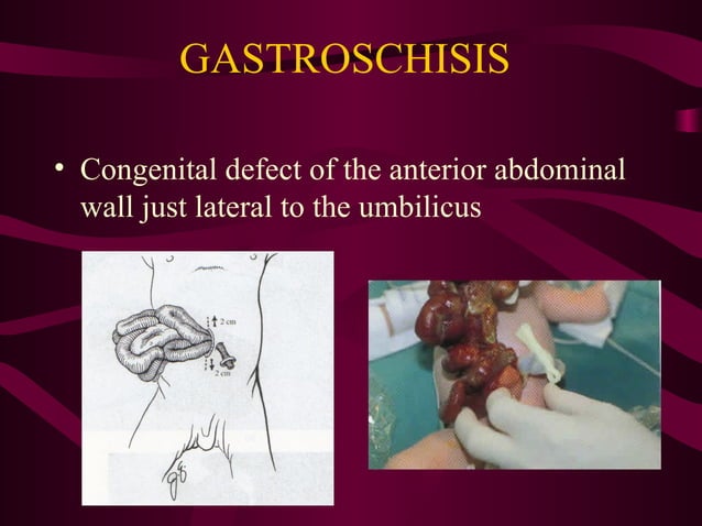 Abdominal-Wall-Defects.ppt by batte John Marvin. | PPT