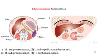 abdominal abscess in peritoneal and retro peritoneum | PPTX