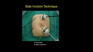 Abdominal Access Techniques in laparoscopy | PPTX