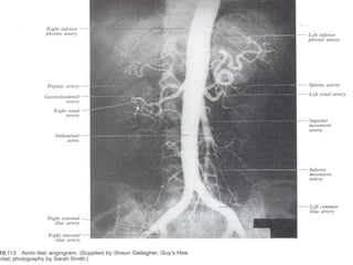 ABDOMINAL AORTA(Arterial Supply Of GIT).ppt