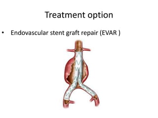 Treatment option
• Endovascular stent graft repair (EVAR )
 