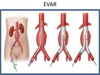EVAR
 