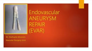 Endovascular
ANEURYSM
REPAIR
(EVAR)
Dr. Huthayfa Ghanem
Vascular Surgery Unit
 