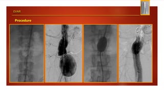 EVAR
Procedure
 