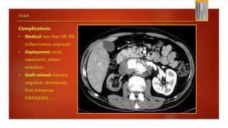 EVAR
Complications
• Medical: less than OR, PIS
(inflammatory response)
• Deployment: renal,
mesenteric, athero-
embolism
• Graft related: fracture,
migration, thrombosis,
limb ischaemia,
ENDOLEAKS, …
 
