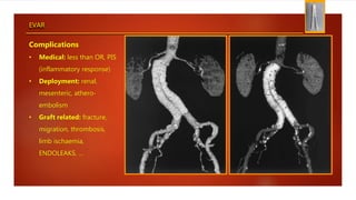 EVAR
Complications
• Medical: less than OR, PIS
(inflammatory response)
• Deployment: renal,
mesenteric, athero-
embolism
• Graft related: fracture,
migration, thrombosis,
limb ischaemia,
ENDOLEAKS, …
 