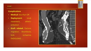 EVAR
Complications
• Medical: less than OR
• Deployment: renal,
mesenteric, athero-
embolism
• Graft related: fracture,
migration, thrombosis,
limb ischaemia,
ENDOLEAKS, …
 