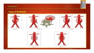 ENDOLEAKS
Types of Endoleaks
 