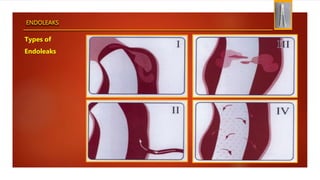 ENDOLEAKS
Types of
Endoleaks
 
