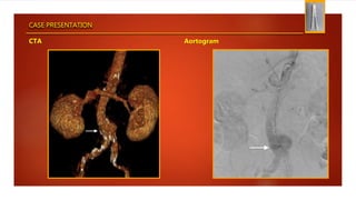 CASE PRESENTATION
AortogramCTA
 