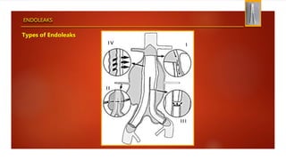 ENDOLEAKS
Types of Endoleaks
 