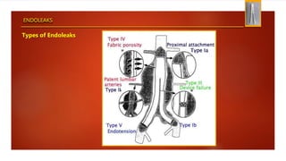 ENDOLEAKS
Types of Endoleaks
 