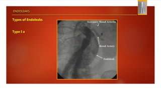 ENDOLEAKS
Types of Endoleaks
Type I a
 