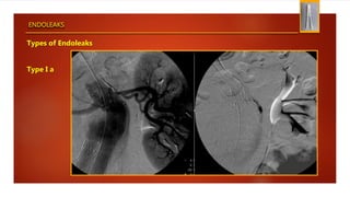 ENDOLEAKS
Types of Endoleaks
Type I a
 
