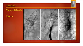 ENDOLEAKS
Types of Endoleaks
Type I a
 