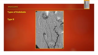 ENDOLEAKS
Types of Endoleaks
Type II
 