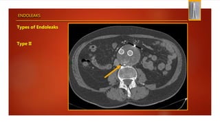 ENDOLEAKS
Types of Endoleaks
Type II
 