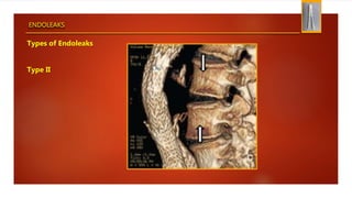 ENDOLEAKS
Types of Endoleaks
Type II
 