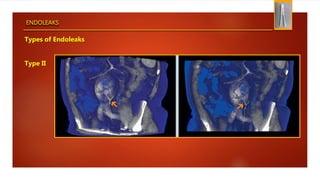ENDOLEAKS
Types of Endoleaks
Type II
 