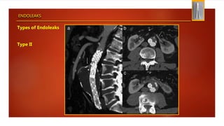 ENDOLEAKS
Types of Endoleaks
Type II
 