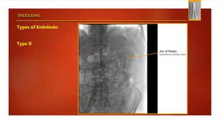 ENDOLEAKS
Types of Endoleaks
Type II
 