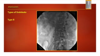 ENDOLEAKS
Types of Endoleaks
Type II
 